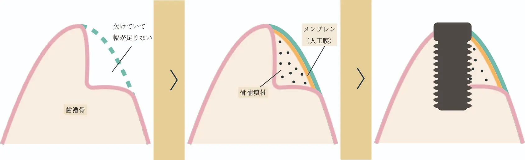 GBR図解