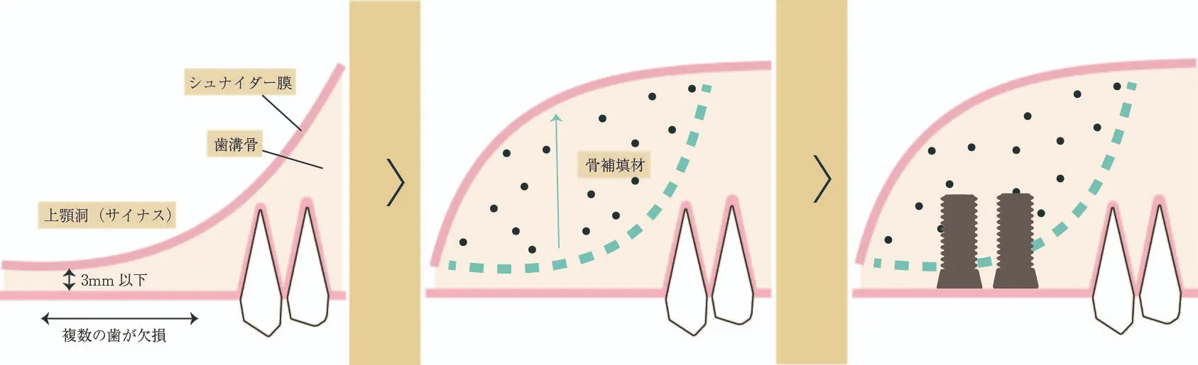 サイナスリフト図解