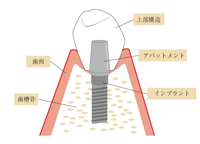 インプラントの上部構造について｜東京インプラント