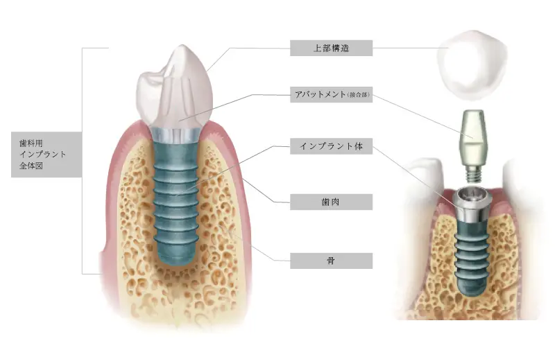 インプラントの構造図解