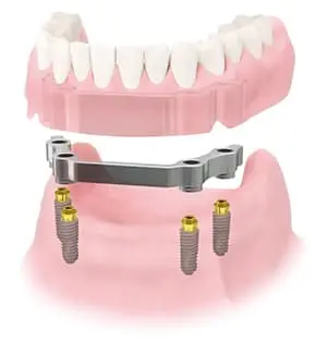 implant_over_denture